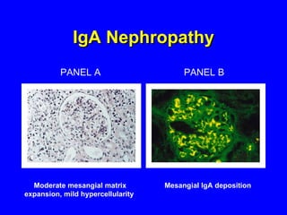 IgA Nephropathy PANEL A PANEL B Moderate mesangial matrix expansion, mild hypercellularity  Mesangial IgA deposition 