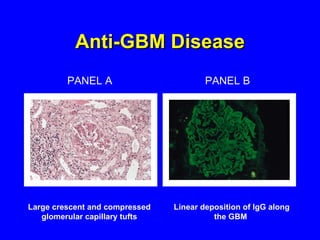 Anti-GBM Disease PANEL A PANEL B Large crescent and compressed glomerular capillary tufts Linear deposition of IgG along the GBM  
