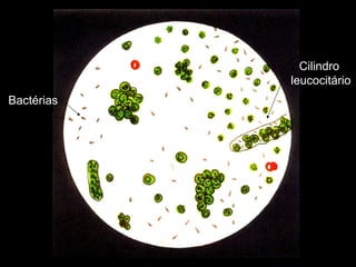 Cilindro  leucocitário Bactérias 