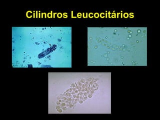 Cilindros Leucocitários 