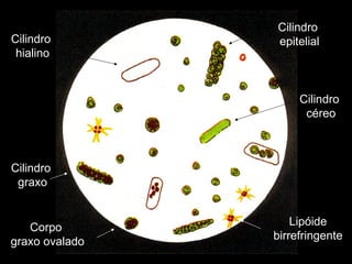 Lipóide birrefringente Cilindro  hialino Corpo  graxo ovalado Cilindro  epitelial Cilindro  céreo Cilindro  graxo 