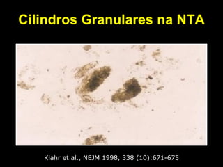 Cilindros Granulares na NTA Klahr et al., NEJM 1998, 338 (10):671-675 