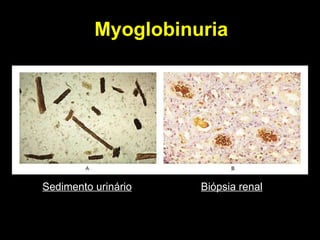 Myoglobinuria Sedimento urinário Biópsia renal 