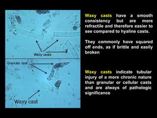 Waxy casts  have a smooth consistency but are more refractile and therefore easier to see compared to hyaline casts.  They commonly have squared off ends, as if brittle and easily broken Waxy casts  indicate tubular injury of a more chronic nature than granular or cellular casts and are always of pathologic significance 