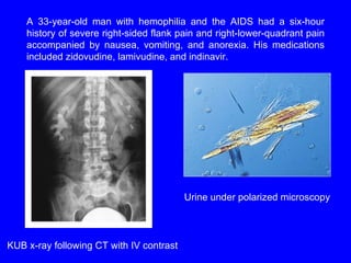 A 33-year-old man with hemophilia and the AIDS had a six-hour history of severe right-sided flank pain and right-lower-quadrant pain accompanied by nausea, vomiting, and anorexia. His medications included zidovudine, lamivudine, and indinavir.  KUB x-ray following CT with IV contrast Urine under polarized microscopy 