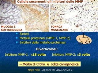 Sintesi  Metallo proteinasi (MMP-1, MMP-2) Inibitori delle metallo-proteinasi Contenuto collageno Diverticolosi: Inibitore MMP-1:  x 18 volte   Inibitore MMP-2: x 3 volte ~  Morbo di Crohn  e  colite collagenosica  Mejer MJW  Dig Liver Dis 2007;39:773-9   MUCOSA E SOTTOMUCOSA TONACA MUSCOLARE Cellule secernenti gli inibitori delle MMP  