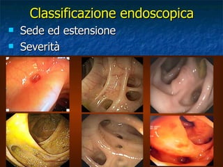 Sede ed estensione Severità   -  Diverticolosi con colon spastico    (pliche edematose, ridondanti, con restringimento del lume)   -  Diverticolosi semplice     (numerosi diverticoli senza alterazioni delle pliche)   -  Diverticoli isolati     (rari diverticoli senza alterazioni delle pliche)   -  Diverticolosi destra   (diverticoli solo nel colon destro senza alterazioni delle pliche) Classificazione endoscopica Almy TP.  N Eng J Med 1980 Naitove A.  J Clin Gastr 1993 