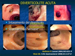 Intasamento del diverticolo  DIVERTICOLITE ACUTA Patogenesi Strozzamento “erniario” West AB   J Clin Gastroenterol 2008;42:1137-8 Stollman N   Lancet 2004;363:631-9 Intasamento Strozzamento 