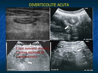 DIVERTICOLITE ACUTA Diagnosi: Ruolo dell’ecografica ETG 70 pz con diverticolite  - 61 ascendente  - 6 discendente - 3 sigma Mizuki MM   Aliment Pharmacol Ther 2005;21:889-97 Diagnosi finale  Limiti 4 non avevano diverticoli  Obesità 1 aveva appendicite   Meteorismo 1 aveva cancro  Operatore   