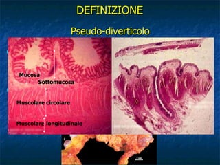 Pseudo-diverticolo Erniazione della mucosa, della sottomucosa e della muscolaris mucosa attraverso la tonaca muscolare circolare nel grasso pericolico Dimensioni: 5-10 mm (fino a 20 mm) DEFINIZIONE Mucosa Sottomucosa Muscolare circolare Muscolare longitudinale 
