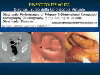 DIVERTICOLITE ACUTA Diagnosi: ruolo della Colonscopia Virtuale 