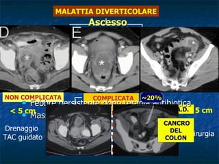 Ascesso Perforazione coperta con organizzazione dello stravaso infiammatorio Febbre persistente dopo terapia antibiotica Massa palpabile  MALATTIA DIVERTICOLARE ASINTOMATICA SINTOMATICA COMPLICATA  NON COMPLICATA DIVERTICOLITE EMORRAGIA ASCESSO PERFORAZIONE STENOSI S.C.A.D. FISTOLA NON COMPLICATA COMPLICATA  ~ 20% ~ 20% ~ 80% ~ 95% ~ 5% < 5 cm Drenaggio  TAC guidato > 5 cm Chirurgia ~ 20% CANCRO DEL COLON 