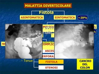 Fistola Tramite tra un ascesso ed un organo o la parete addominale: - Vescica (nei maschi)  - Utero  Aria e/o secrezioni  - Vagina   purulente o stercoracee - Tenue MALATTIA DIVERTICOLARE ASINTOMATICA SINTOMATICA COMPLICATA  NON COMPLICATA DIVERTICOLITE EMORRAGIA ASCESSO PERFORAZIONE STENOSI S.C.A.D. FISTOLA NON COMPLICATA COMPLICATA  ~ 20% ~ 20% ~ 80% ~ 95% ~ 5% CANCRO DEL COLON 