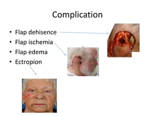 Complication
• Flap dehisence
• Flap ischemia
• Flap edema
• Ectropion
 