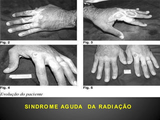 SI NDRO ME AG UDA DA RADI AÇÃO
 