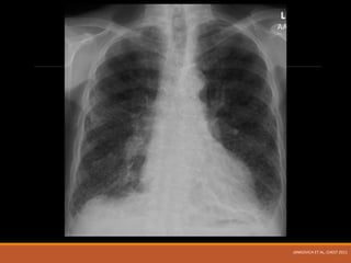 JANKOVICH ET AL, CHEST 2011
 