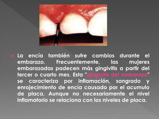  La encía también sufre cambios durante el
embarazo. Frecuentemente, las mujeres
embarazadas padecen más gingivitis a partir del
tercer o cuarto mes. Esta "gingivitis del embarazo"
se caracteriza por inflamación, sangrado y
enrojecimiento de encía causado por el acumulo
de placa. Aunque no necesariamente el nivel
inflamatorio se relaciona con los niveles de placa.
 