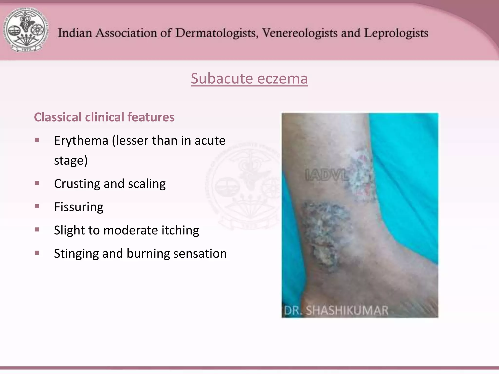 ECZEMA.ppt