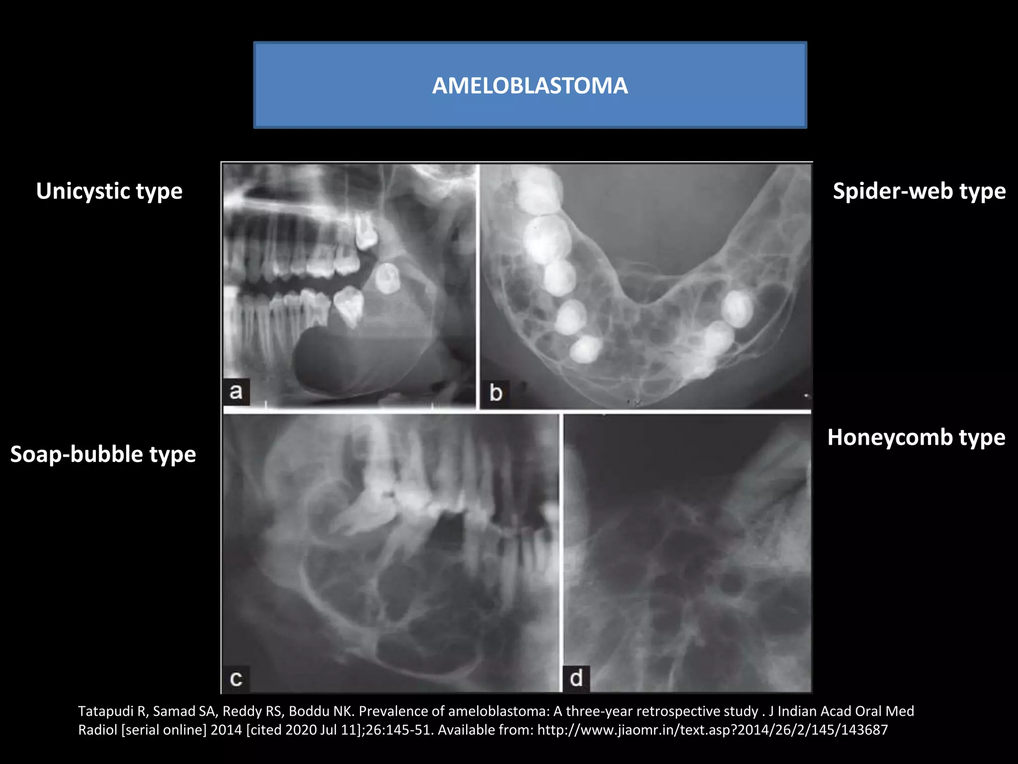 central-giant-cell-granuloma-from-diagnosis-to-management-pptx