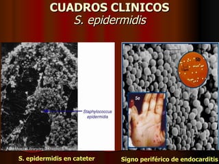 CUADROS CLINICOS S. epidermidis Signo periférico de endocarditis S. epidermidis en cateter 