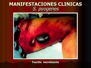 MANIFESTACIONES CLINICAS S. pyogenes Fascitis  necrotizante 