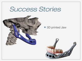 Success Stories 
3D printed Jaw 
 
