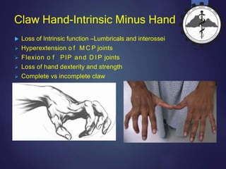 Claw hand | PPTX