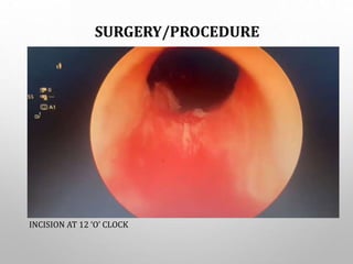 SURGERY/PROCEDURE
INCISION AT 12 ‘O’ CLOCK
 