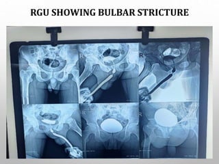 RGU SHOWING BULBAR STRICTURE
 
