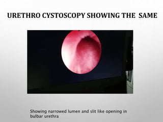 URETHRO CYSTOSCOPY SHOWING THE SAME
Showing narrowed lumen and slit like opening in
bulbar urethra
 