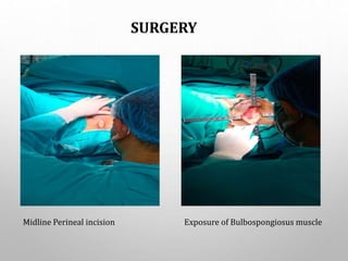 SURGERY
Midline Perineal incision Exposure of Bulbospongiosus muscle
 