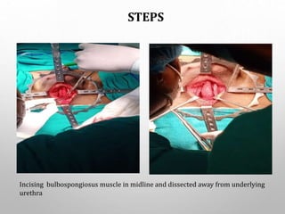 STEPS
Incising bulbospongiosus muscle in midline and dissected away from underlying
urethra
 