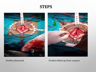 STEPS
Urethra dissected Urethra lifted up from corpora
 