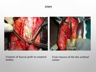 Fixation of buccal graft to corporal
bodies
Final closure of the the urethral
lumen
STEPS
 