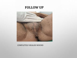 FOLLOW UP
COMPLETELY HEALED WOUND
 