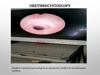 URETHROCYSTOSCOPY
Urethra- Luminal narrowing from mid penile urethra to membranous
urethra.
 
