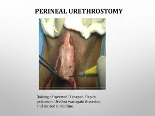 PERINEAL URETHROSTOMY
Raising of inverted U shaped flap in
perineum, Urethra was again dissected
and incised in midline.
 