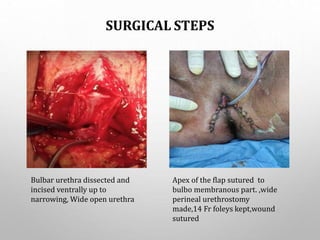 SURGICAL STEPS
Bulbar urethra dissected and
incised ventrally up to
narrowing, Wide open urethra
Apex of the flap sutured to
bulbo membranous part. ,wide
perineal urethrostomy
made,14 Fr foleys kept,wound
sutured
 