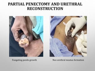 PARTIAL PENECTOMY AND URETHRAL
RECONSTRUCTION
Fungating penile growth Neo urethral meatus formation
 