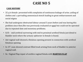 CASE NO 5
CASE HISTORY
• 32 y/o female presented with complaints of continuous leakage of urine ,soiling of
clothes and a pervading ammoniacal stench leading to great embarrasment and
social stigma
• She had undergone obstructed labour around 3 years before and was having this
problem since then.She was previously evaluated at sgpgi but could not be operated
due to repeated date and monetary problems.
• O/E-- mid urethral narrowing with mid to proximal urethral fistula just distal to
bladder neck where the urinary sphincter in female is found.
• Ant vaginal wall showed a fistulous opening present in connection with urethral
fistulous opening
• Ix :CT scan showed contrast filled track arising from neck of bladder to anterior
vaginal wall.
• Sx : Vaginal Flap repair of urethro vaginal fistula with MARTIUS FLAP
 
