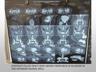 CONTRAST FILLED TRACT SEEN ARISING FROM NECK OF BLADDER TO
THE ANTERIOR VAGINAL WALL
 