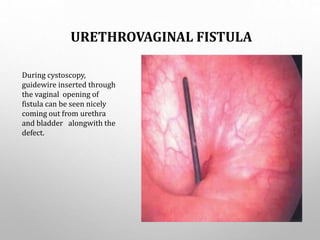 URETHROVAGINAL FISTULA
During cystoscopy,
guidewire inserted through
the vaginal opening of
fistula can be seen nicely
coming out from urethra
and bladder alongwith the
defect.
 