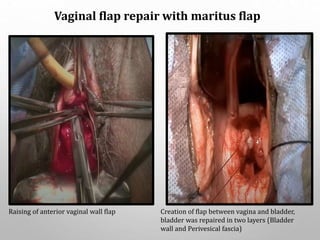 Vaginal flap repair with maritus flap
Raising of anterior vaginal wall flap Creation of flap between vagina and bladder,
bladder was repaired in two layers (Bladder
wall and Perivesical fascia)
 