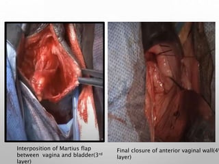 Interposition of Martius flap
between vagina and bladder(3rd
layer)
Final closure of anterior vaginal wall(4t
layer)
 
