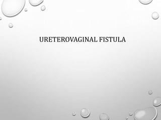 URETEROVAGINAL FISTULA
 
