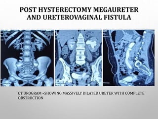 POST HYSTERECTOMY MEGAURETER
AND URETEROVAGINAL FISTULA
CT UROGRAM –SHOWING MASSIVELY DILATED URETER WITH COMPLETE
OBSTRUCTION
 