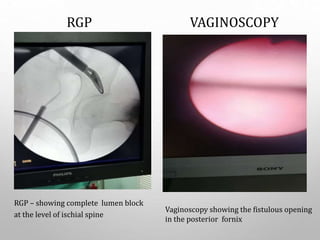RGP – showing complete lumen block
at the level of ischial spine
Vaginoscopy showing the fistulous opening
in the posterior fornix
RGP VAGINOSCOPY
 
