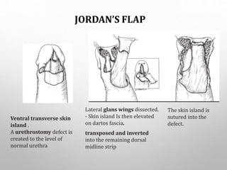 JORDAN’S FLAP
Lateral glans wings dissected.
- Skin island Is then elevated
on dartos fascia.
transposed and inverted
into the remaining dorsal
midline strip
Ventral transverse skin
island .
A urethrostomy defect is
created to the level of
normal urethra
The skin island is
sutured into the
defect.
 