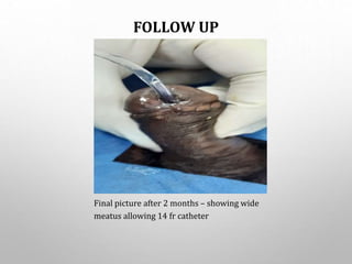 FOLLOW UP
Final picture after 2 months – showing wide
meatus allowing 14 fr catheter
 