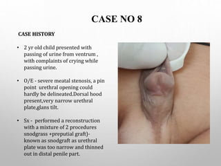 CASE NO 8
CASE HISTORY
• 2 yr old child presented with
passing of urine from ventrum ,
with complaints of crying while
passing urine.
• O/E - severe meatal stenosis, a pin
point urethral opening could
hardly be delineated.Dorsal hood
present,very narrow urethral
plate,glans tilt.
• Sx - performed a reconstruction
with a mixture of 2 procedures
snodgrass +preputial graft)-
known as snodgraft as urethral
plate was too narrow and thinned
out in distal penile part.
 